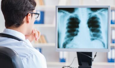 Advances in Lung Cancer Treatment Resulting in Lower Death Rates