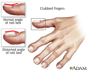 clubbed fingers a symptom of lung cancer