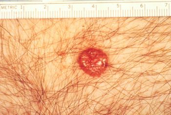 Basal Cell Carcinoma