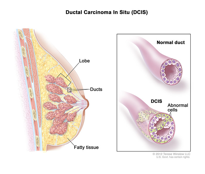 breast cancer type - Ductal Carcinoma in Situ (DCIS) medical illustration provided by the breast cancer specialists at brevard county