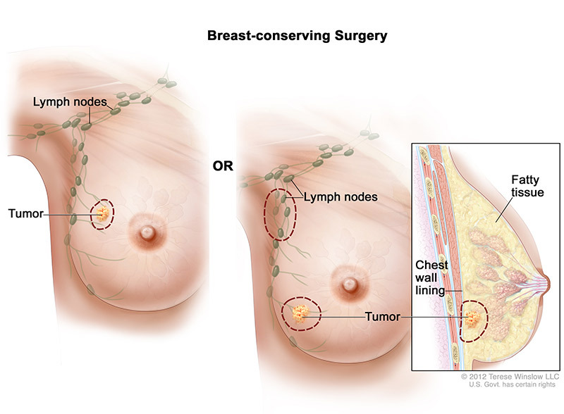 medical illustration of breast-conserving surgery