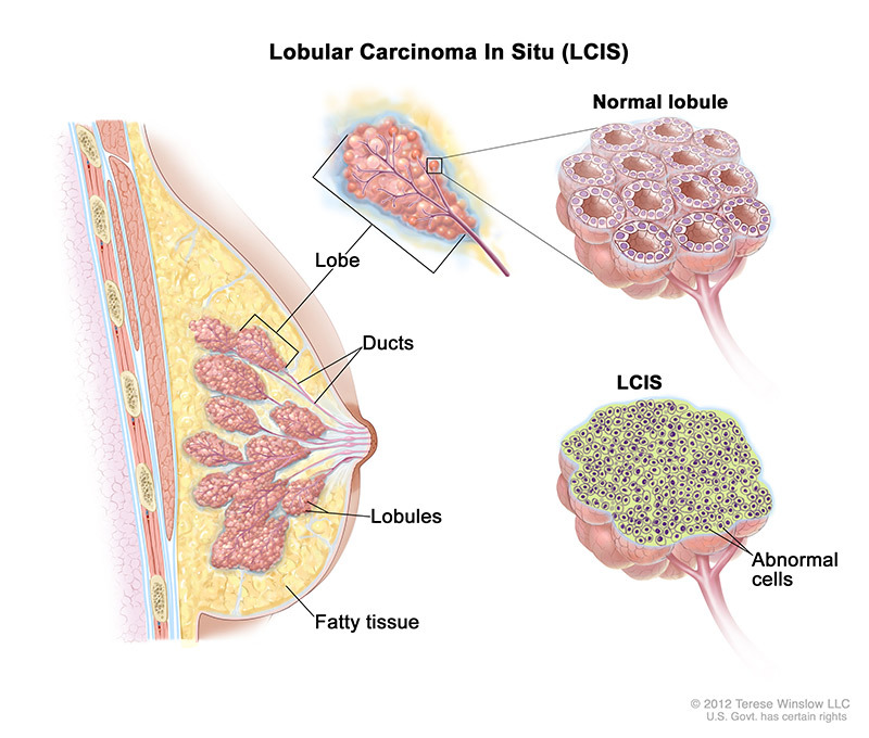 breast cancer type - Lobular Carcinoma in Situ (LCIS) medical illustration provided by the breast cancer specialists at brevard county