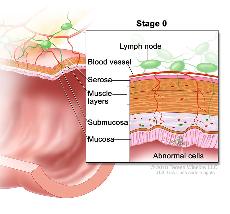 medical illustration of Stage 0 Colorectal Cancer