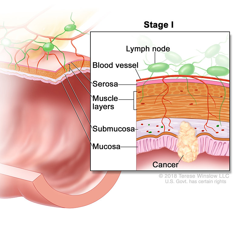 medical illustration of Stage 1 Colorectal Cancer