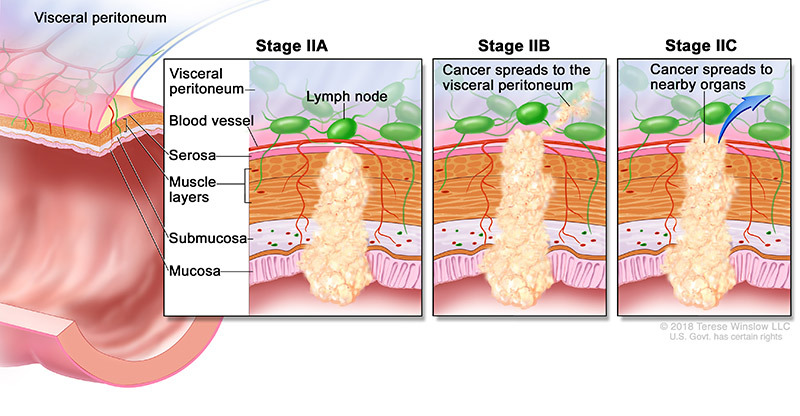 medical illustration of Stage 2 Colorectal Cancer