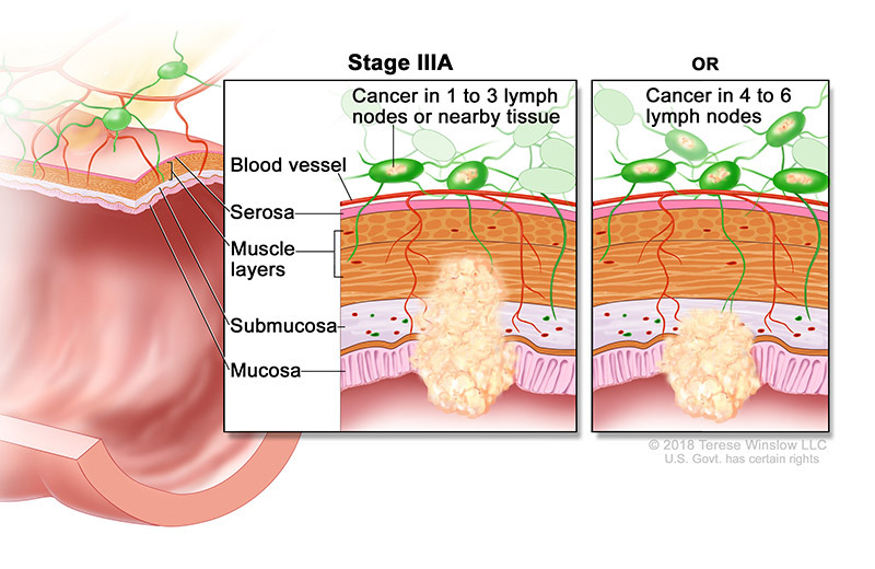 medical illustration of Stage 3A Colorectal Cancer