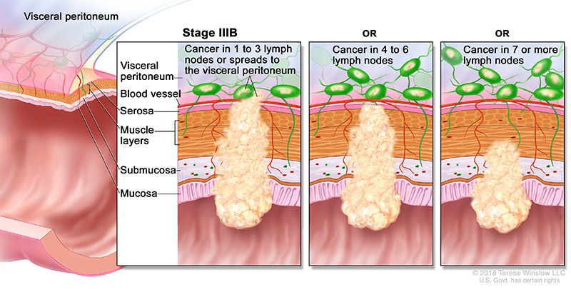 medical illustration of Stage 3B Colorectal Cancer