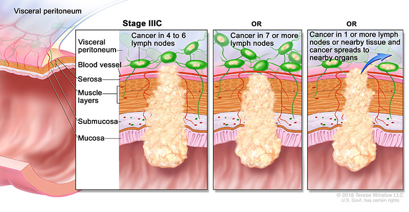 medical illustration of Stage 3C Colorectal Cancer
