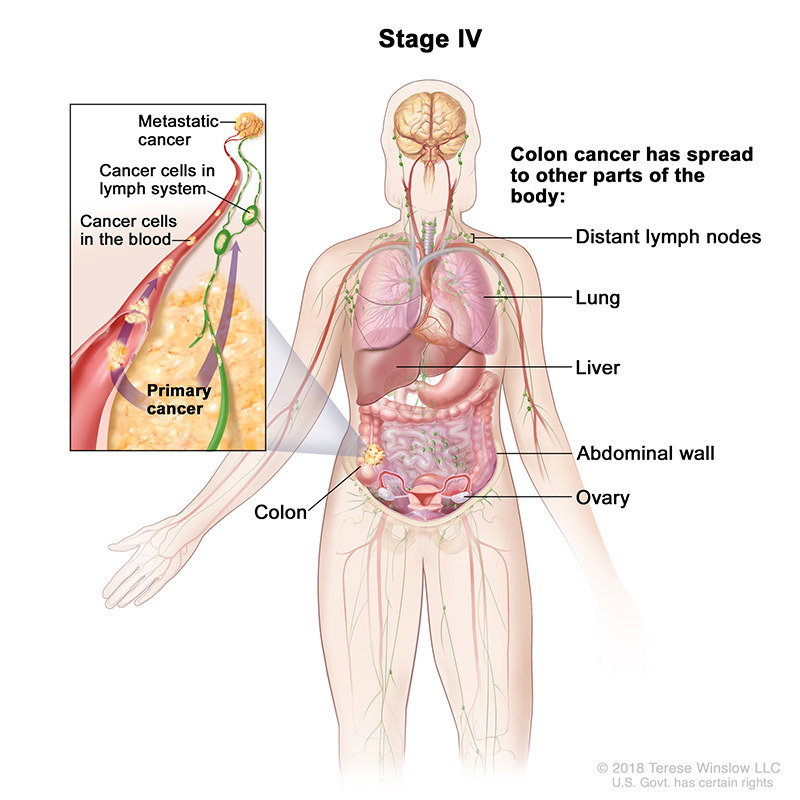 medical illustration of Stage 4 Colorectal Cancer