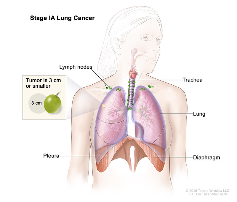 stage 1A of lung cancer - illustration