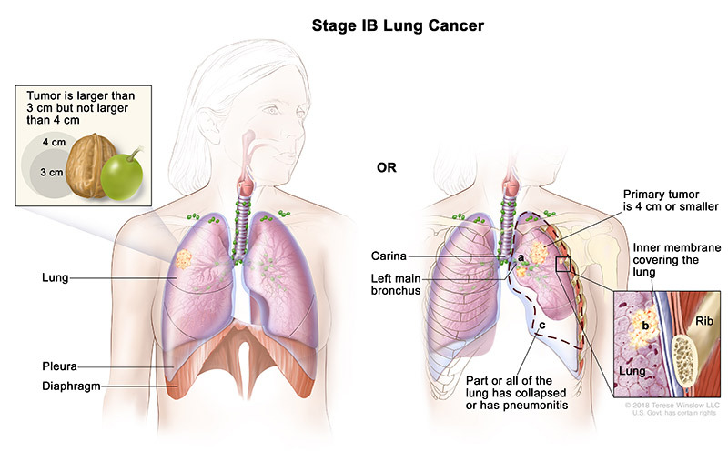 stage 1B of lung cancer - illustration