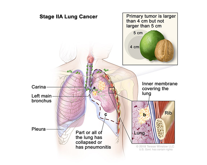 stage 2A of lung cancer - illustration