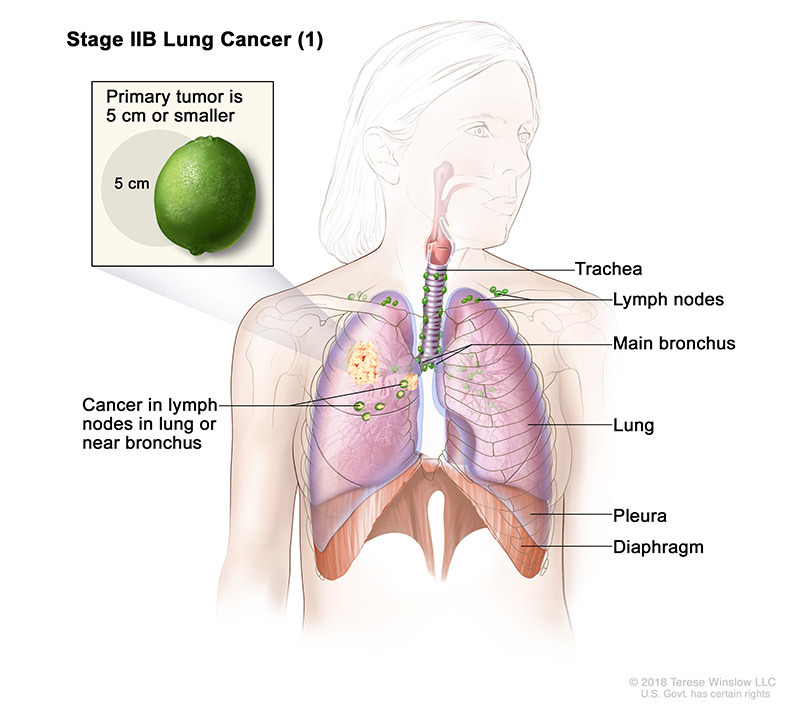 stage 2B part 1 of lung cancer - illustration