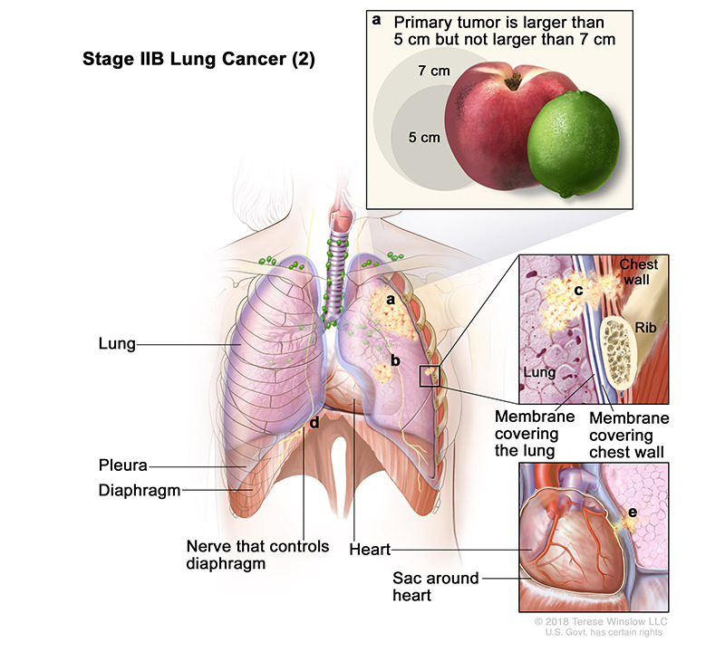 stage 2B part 2 of lung cancer - illustration