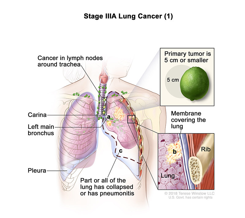 stage 3A part 1 of lung cancer - illustration