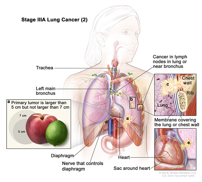 stage 3A part 2 of lung cancer - illustration