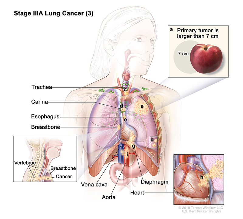 stage 3A part 3 of lung cancer - illustration