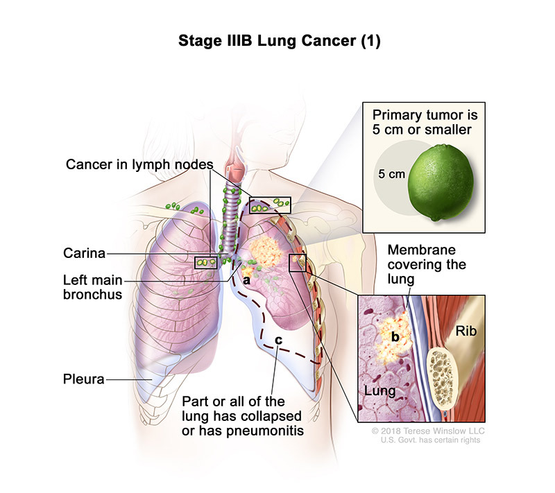 stage 3B part 1 of lung cancer - illustration