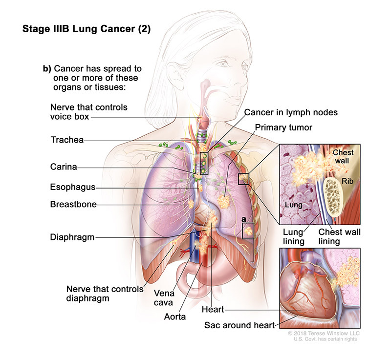 stage 3B part 2 of lung cancer - illustration