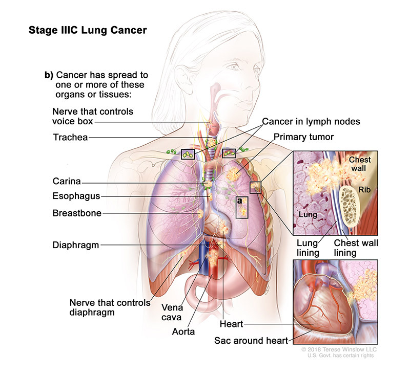 stage 3C of lung cancer - illustration