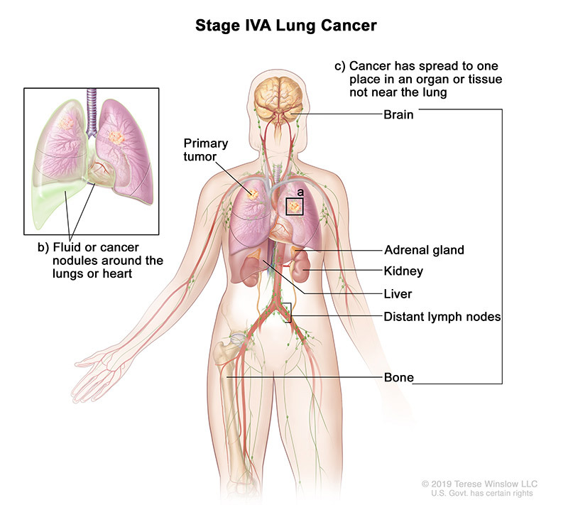 stage 4A of lung cancer - illustration