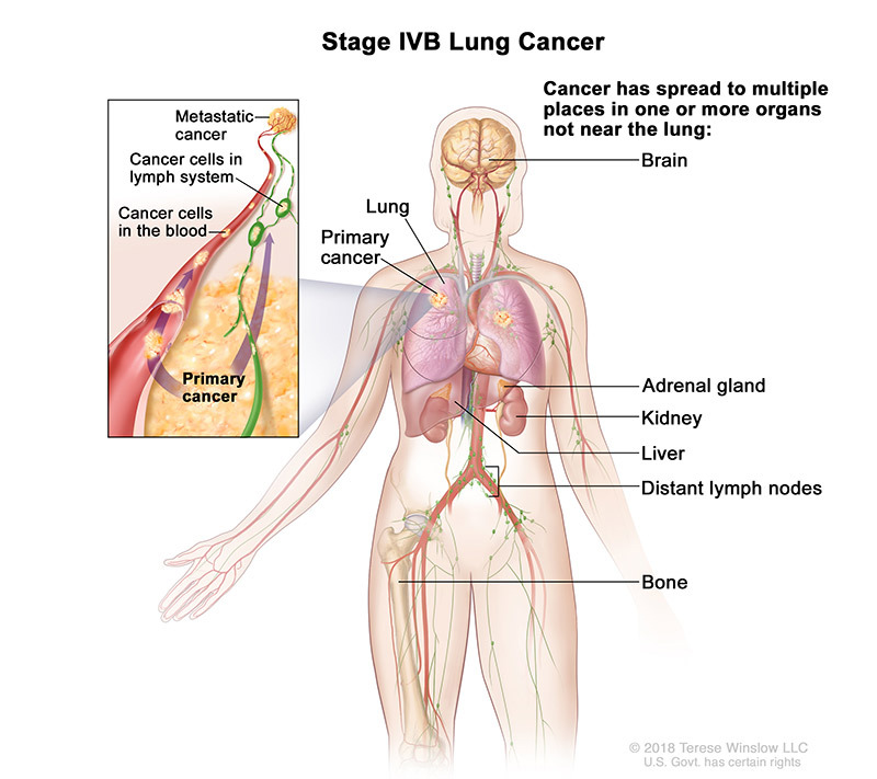 stage 4B of lung cancer - illustration