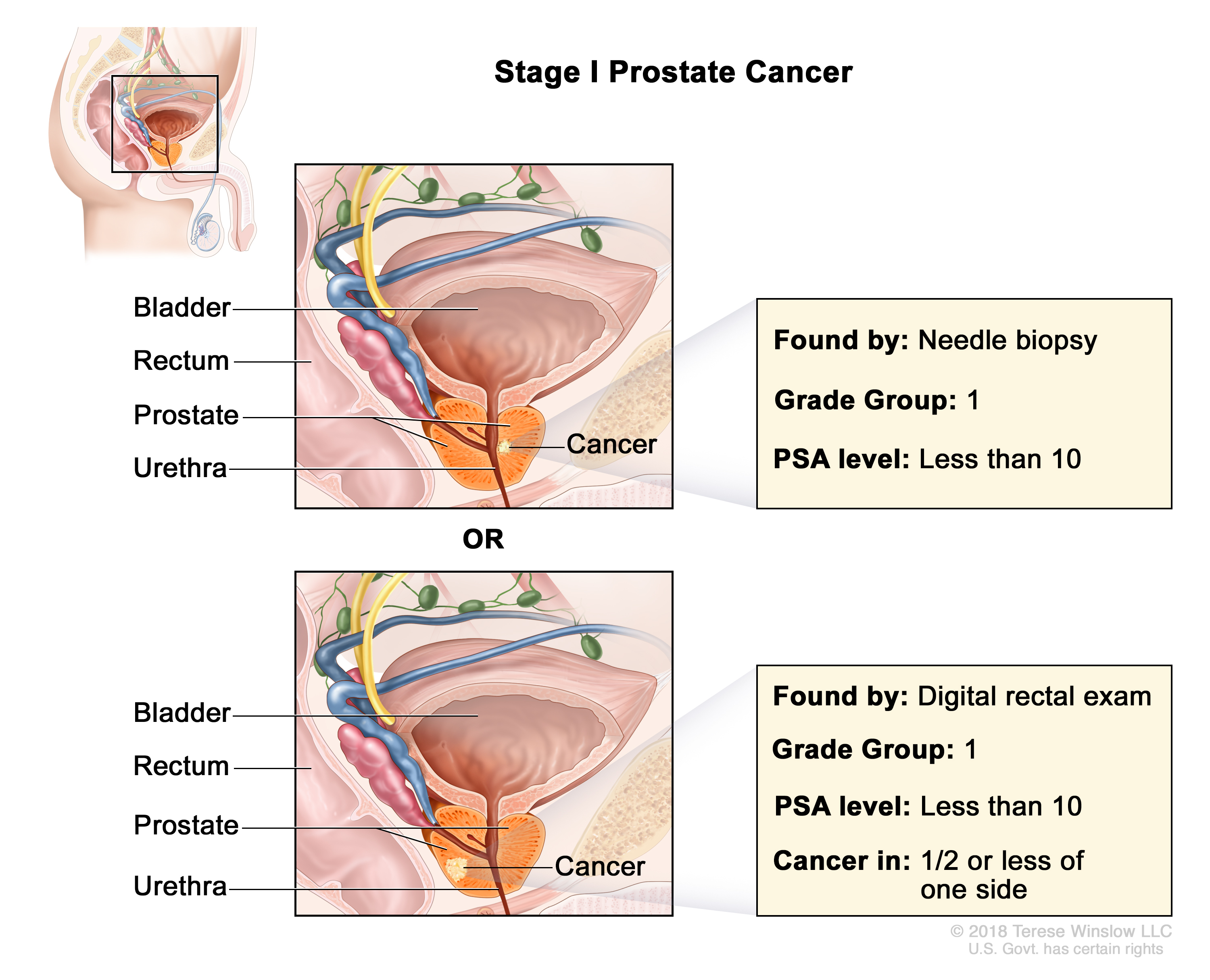 prostate cancer stage 1 illustration