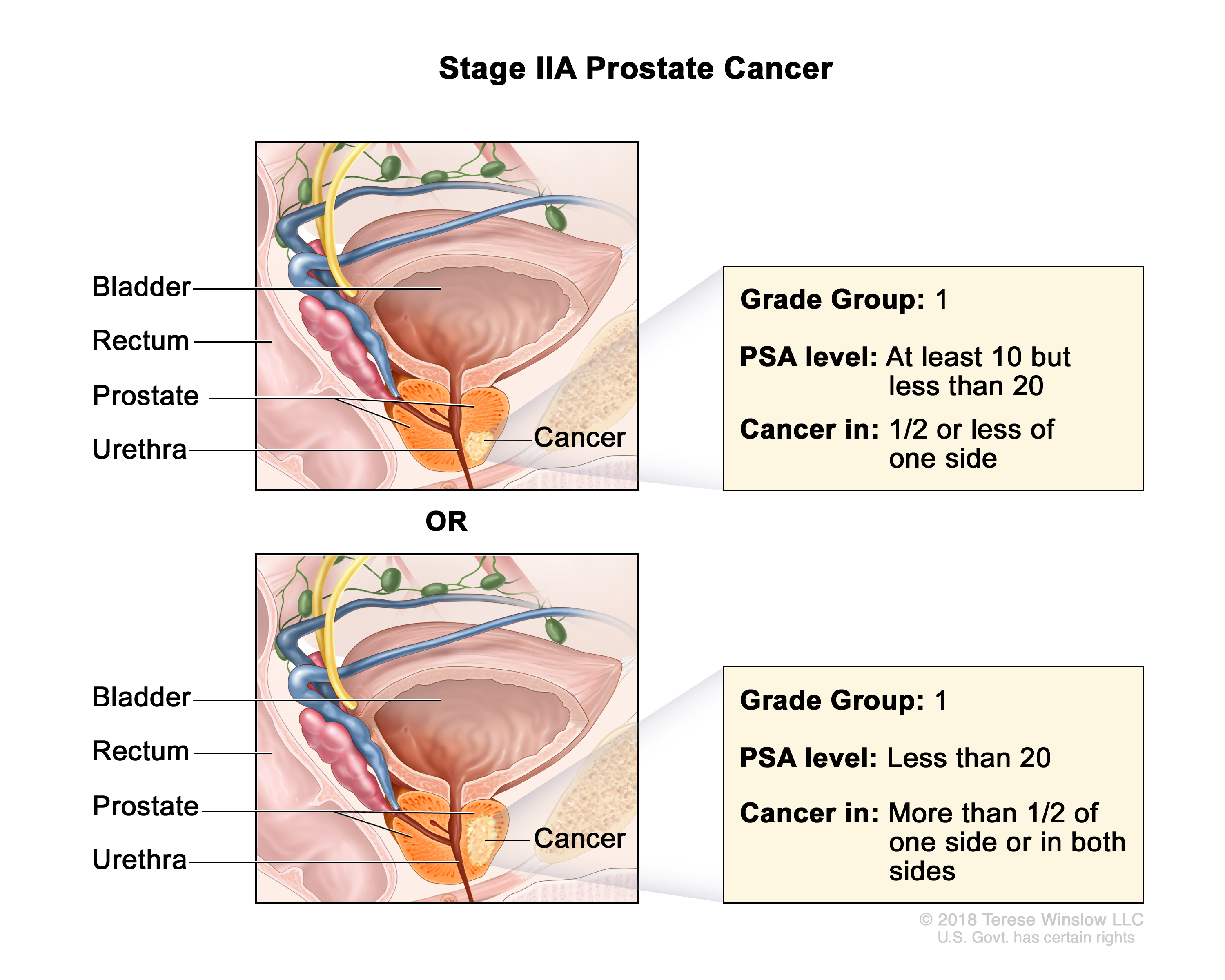 prostate cancer stage 2a illustration
