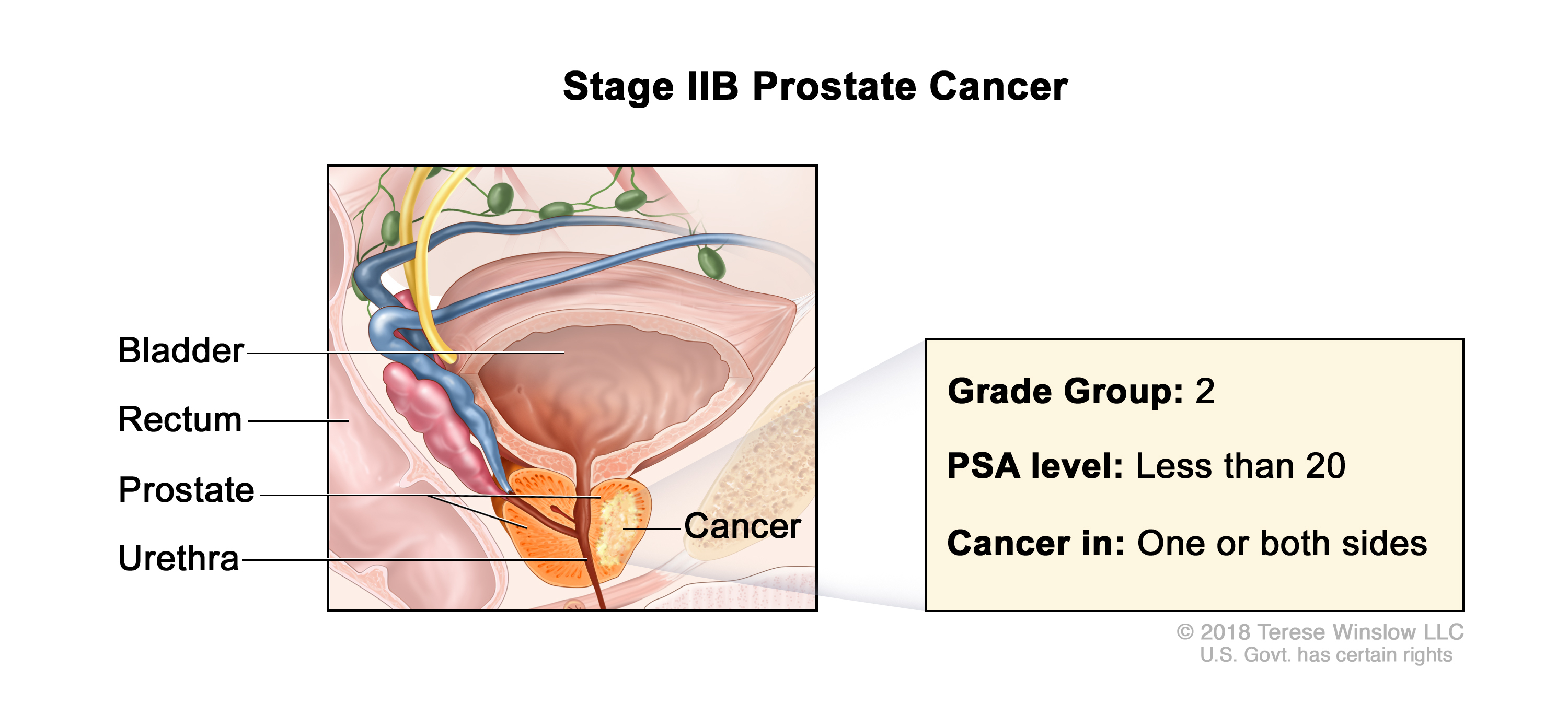 prostate cancer stage 2b illustration