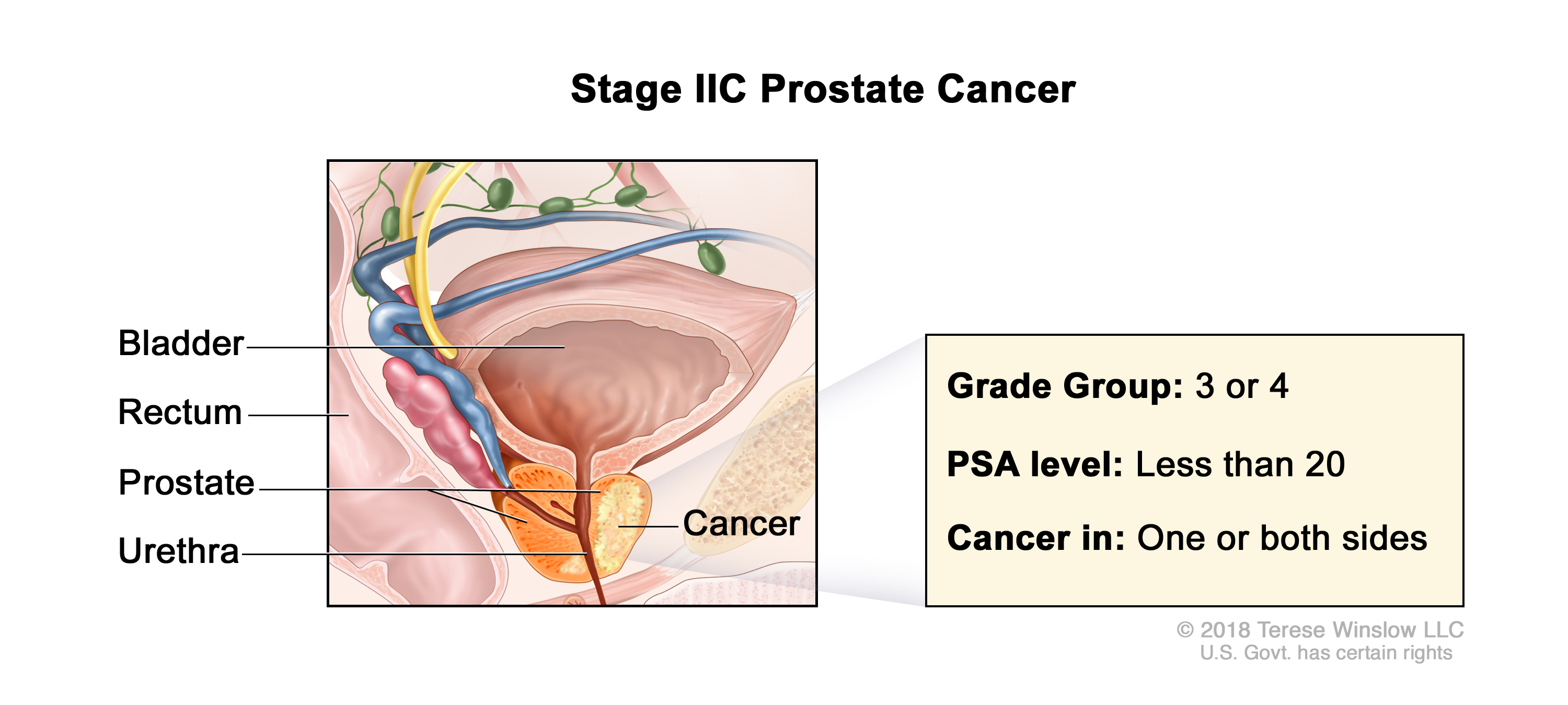 prostate cancer stage 2c illustration