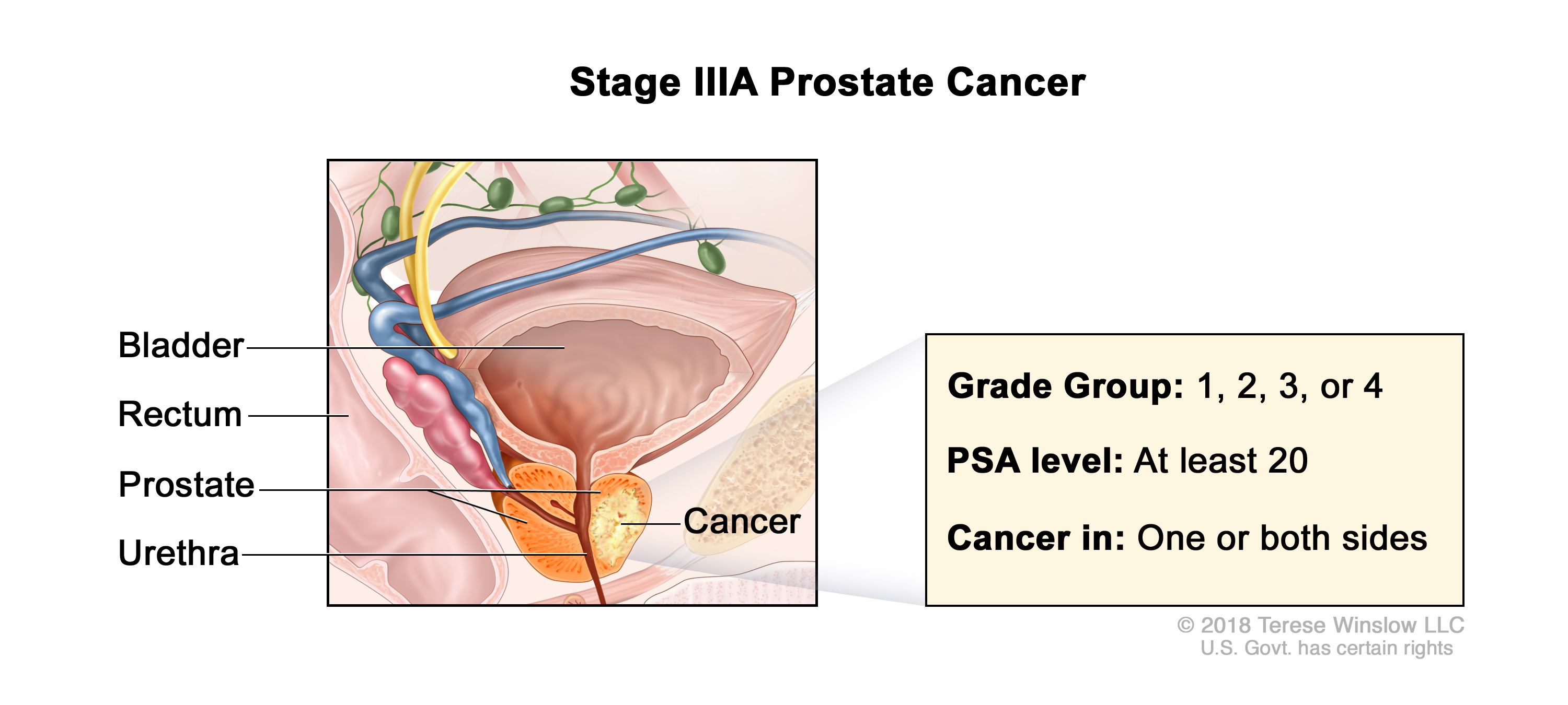 prostate cancer stage 3a illustration