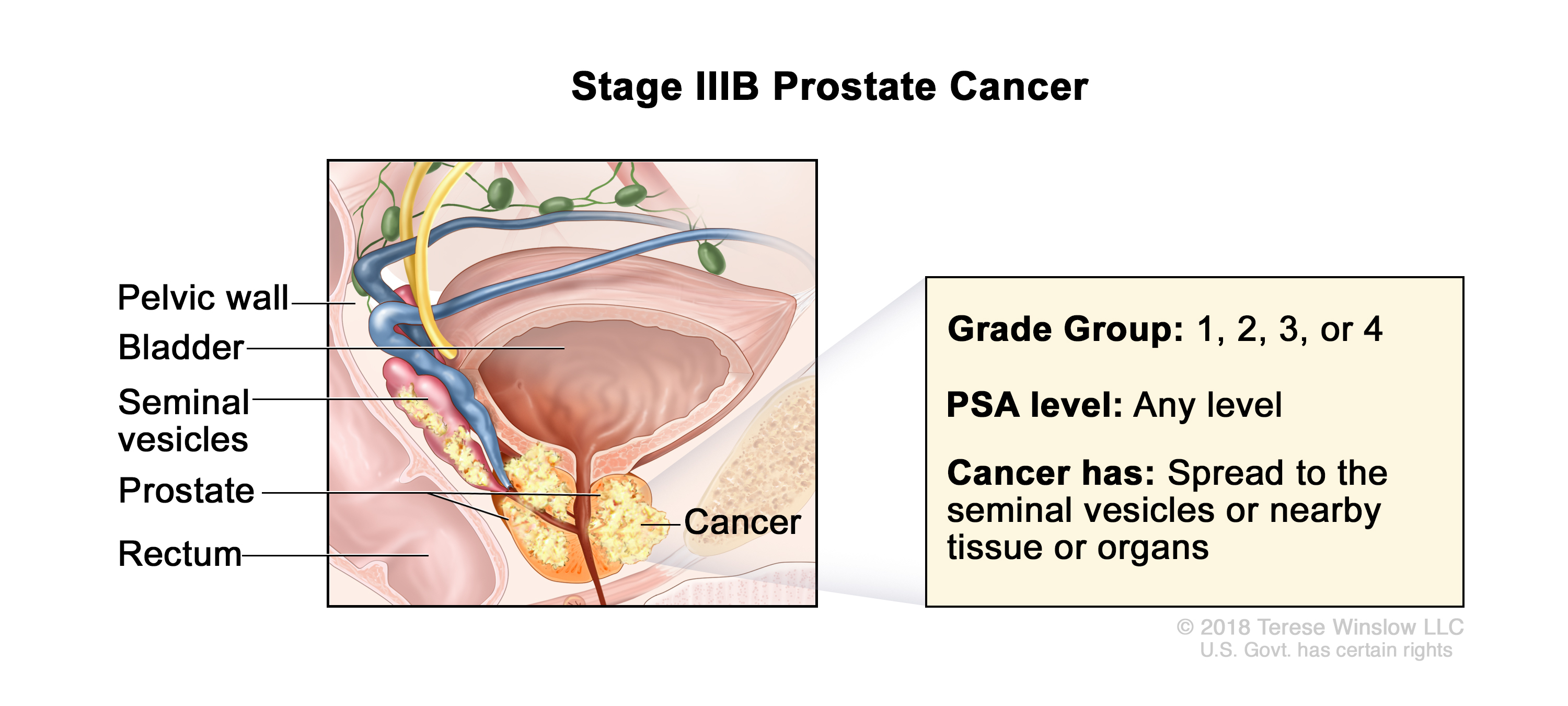 prostate cancer stage 3b illustration