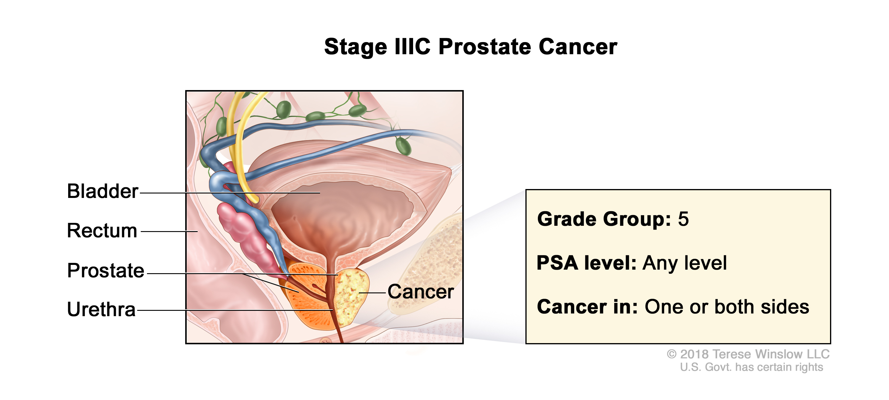 prostate cancer stage 3c illustration