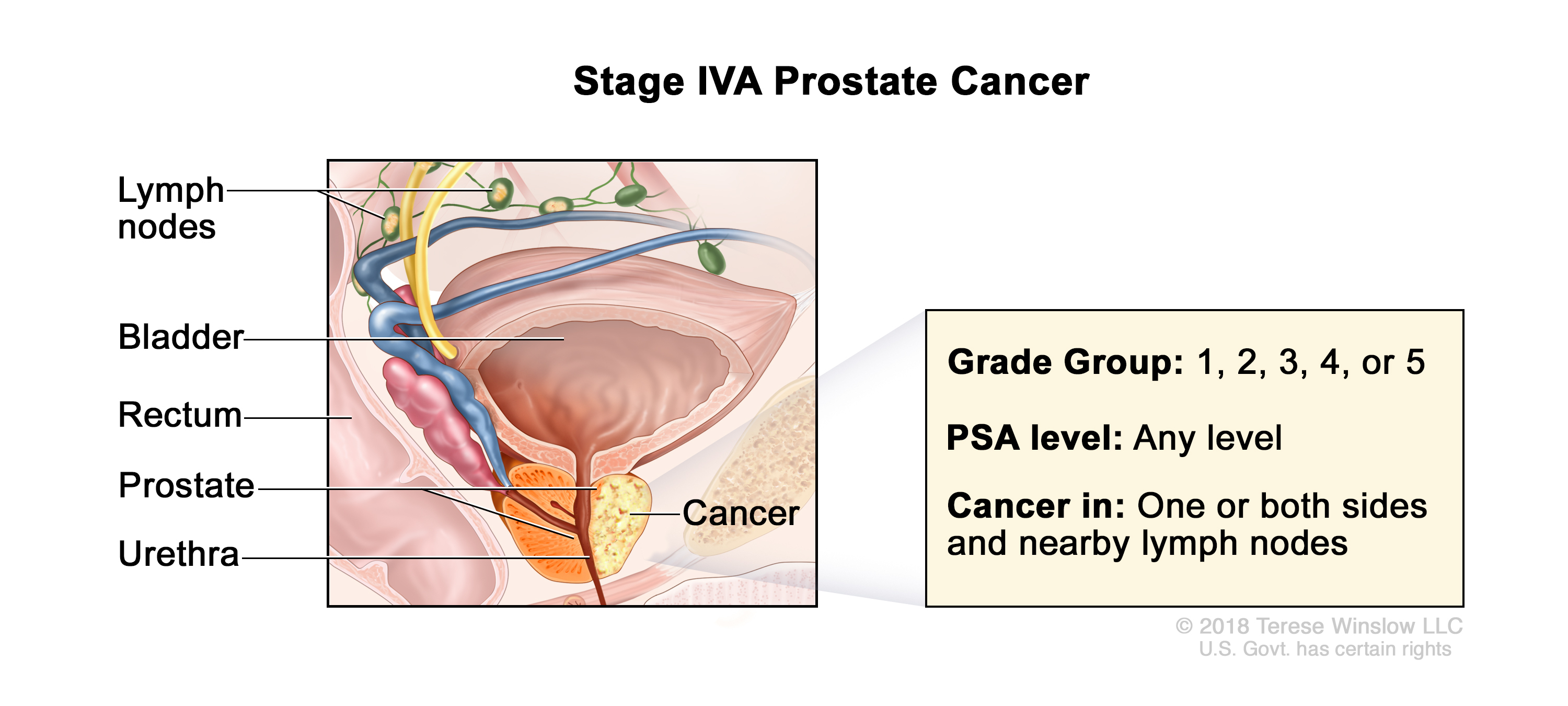 prostate cancer stage 4a illustration