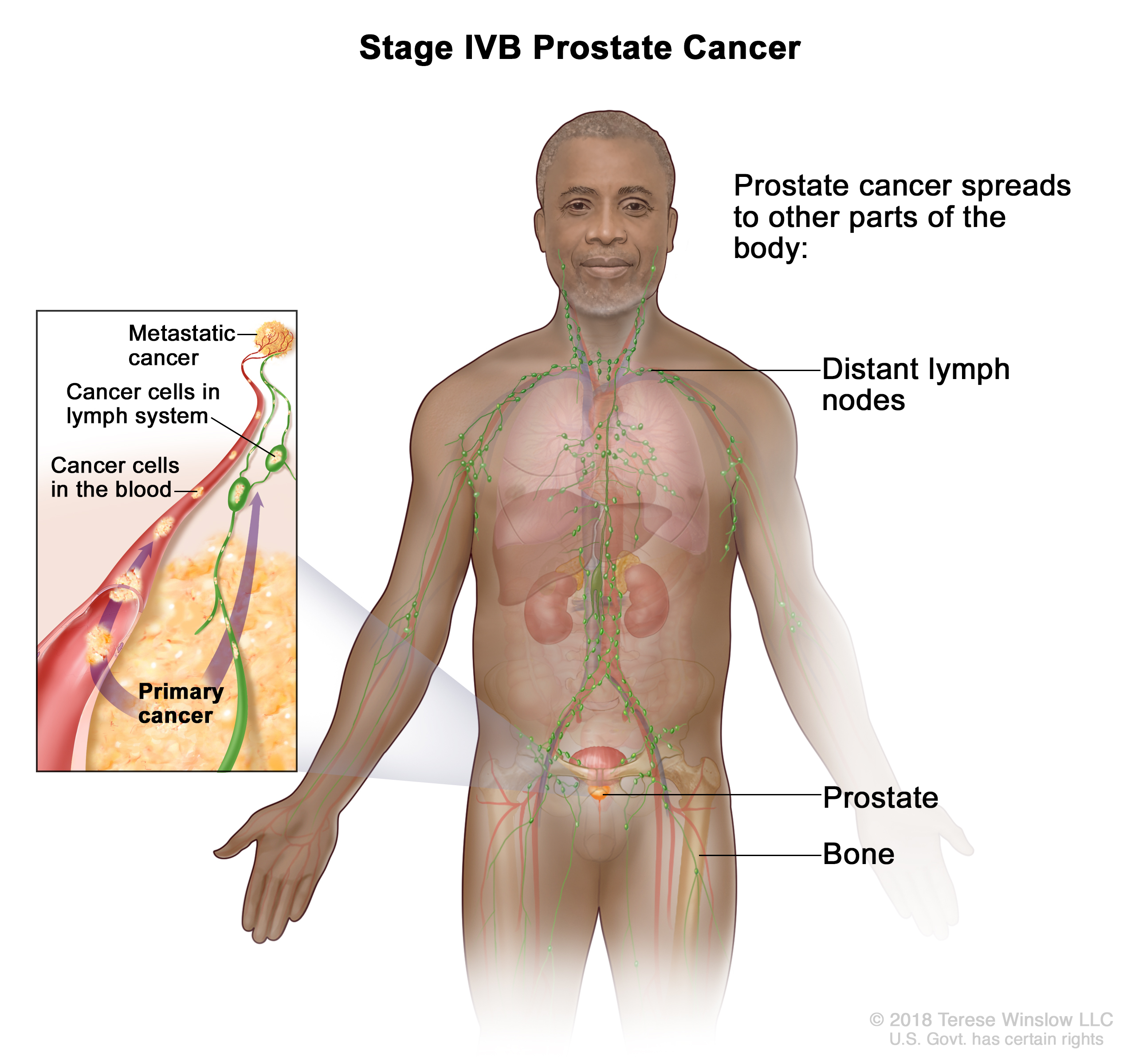 prostate cancer stage 4b illustration